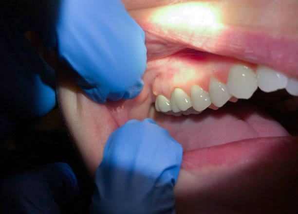 Best Dentist for Tooth Abscess  in Santee, SC